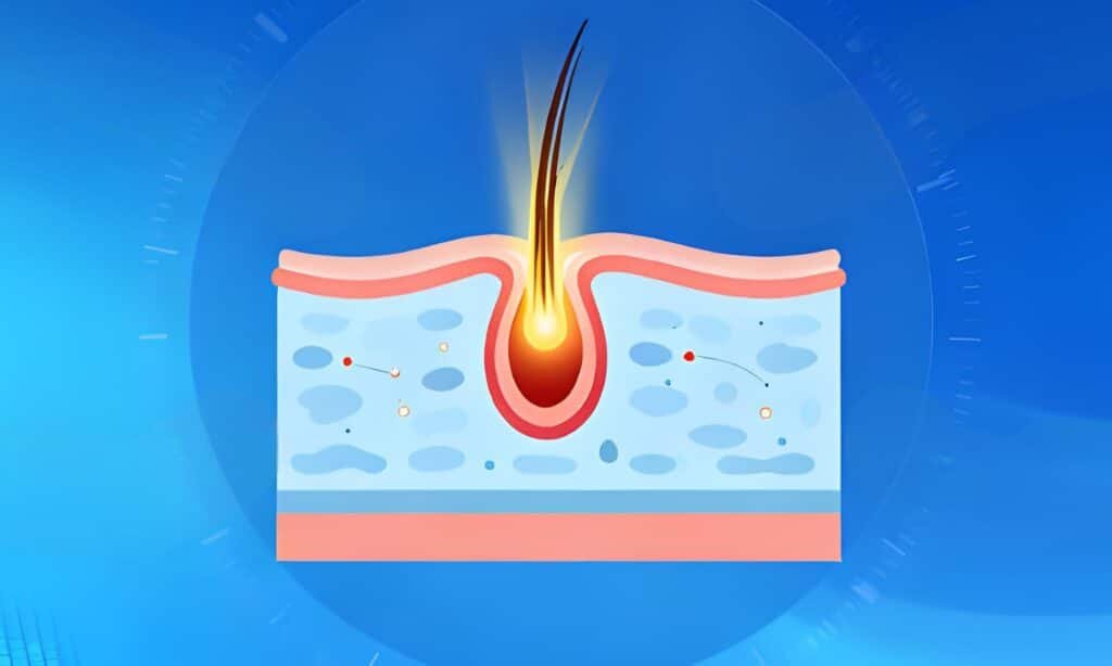 what is ipl hair removal