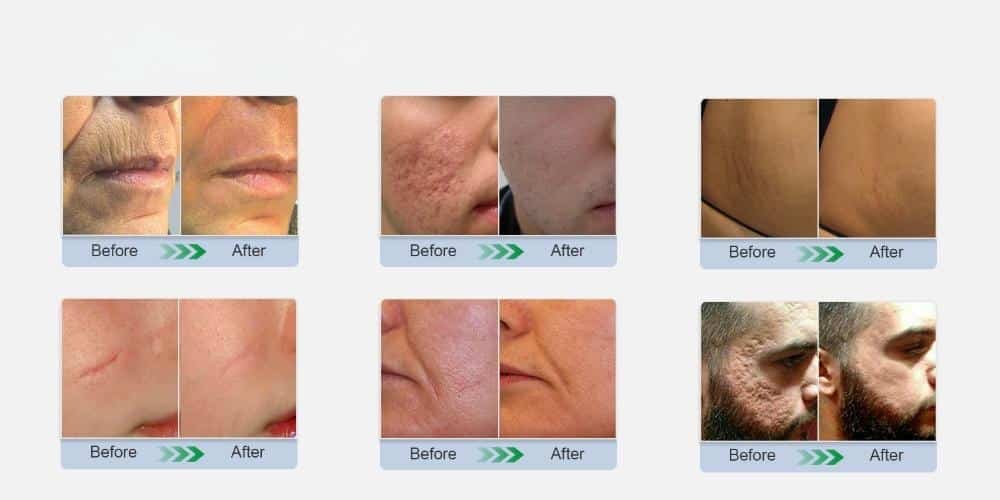 CO2 Fractional Laser Machine Effect