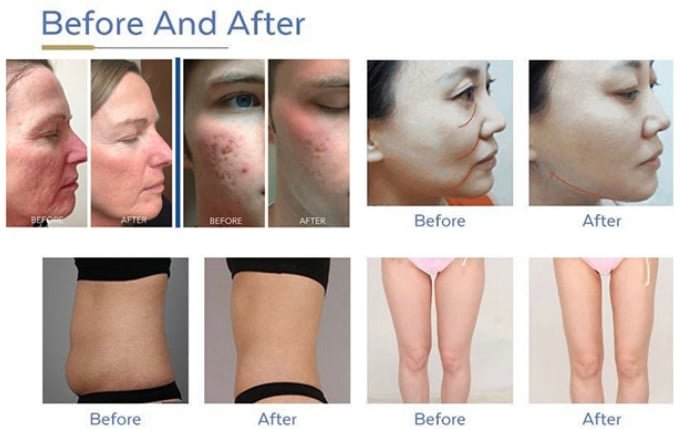 HIFU 7D Machine Before and After