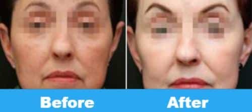 face plasma before and after