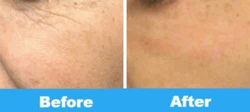 plasma eyes before and after