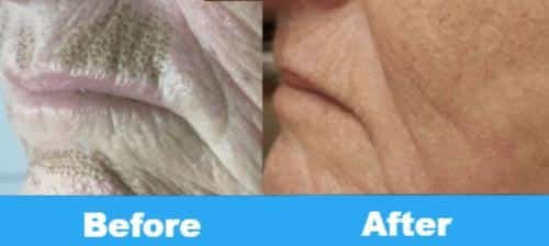 plasma for face before and after