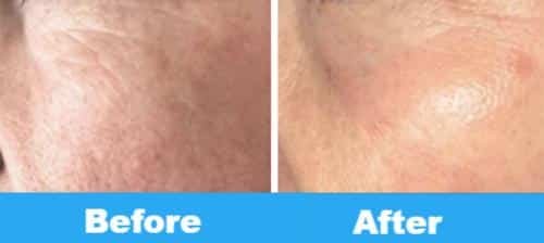plasma under eye before and after